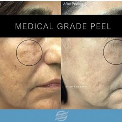 before and after medical grade peel