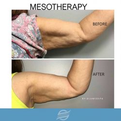 before and after mesotherapy