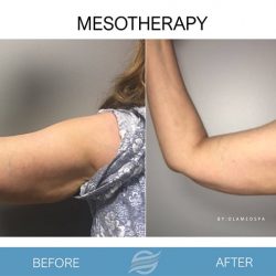 before and after mesotherapy