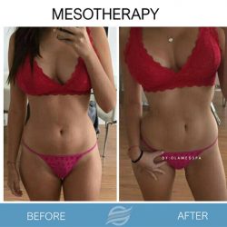 before and after mesotherapy