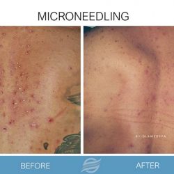 before and after microneedling