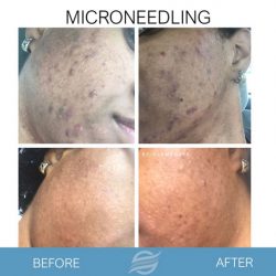 before and after microneedling