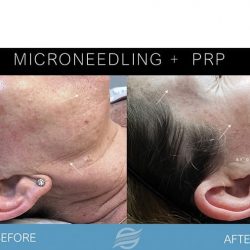 before and after mirconeedling and prp