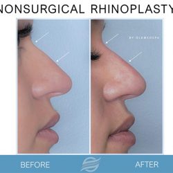 before and after nonsurgical rhinoplasty