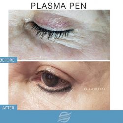 before and after plasma pen