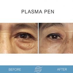 before and after plasma pen