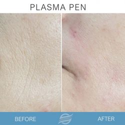 before and after plasma pen