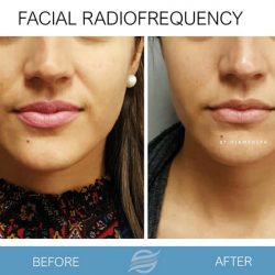 before and after facial radiofrequency