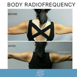 before and after body radiofrequency