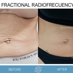 before and after fractional radiofrecuency