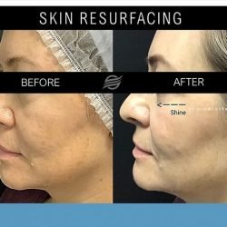 before and after skin resurfacing