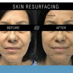 before and after skin resurfacing