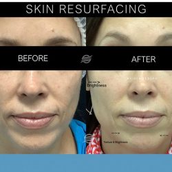 before and after skin resurfacing