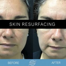 before and after skin resurfacing