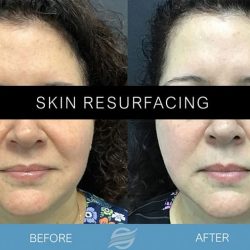 before and after skin resurfacing