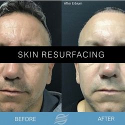 before and after skin resurfacing