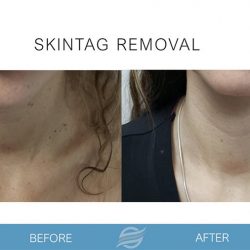 before and after skintag removal