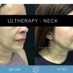 before and after ultherapy