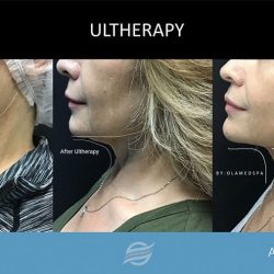 before and after ultherapy